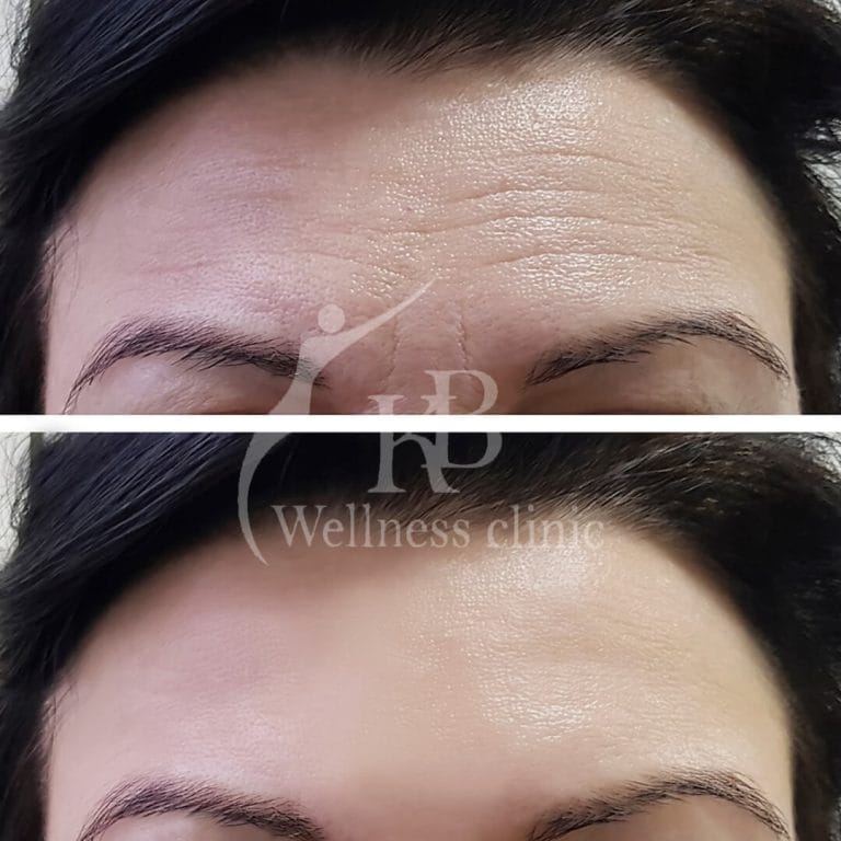 Botox1 at KB Wellness Clinic