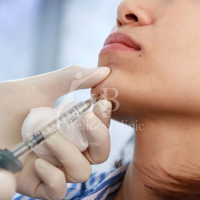 Fillers1 at KB Wellness Clinic