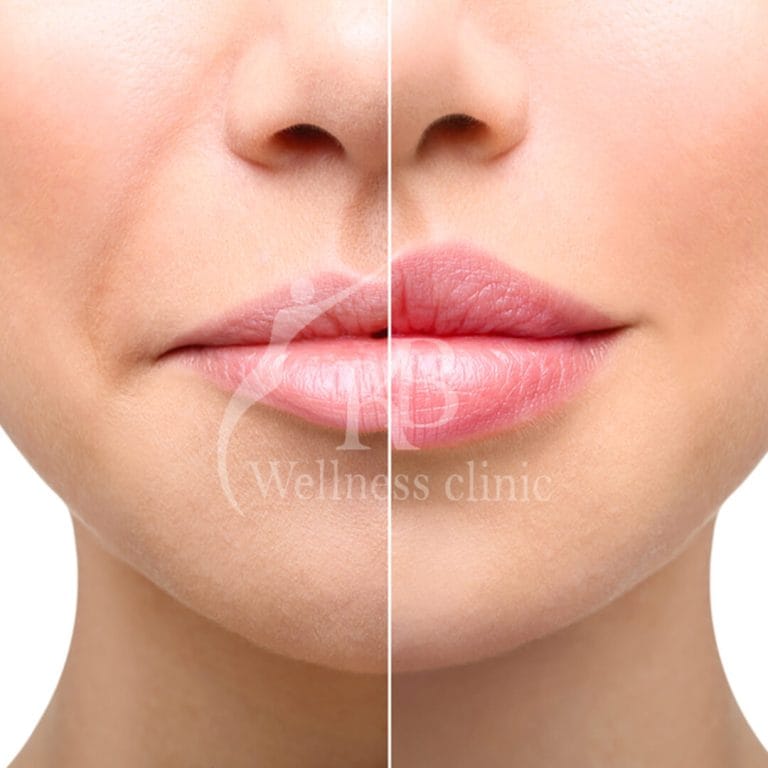 Fillers2 at KB Wellness Clinic