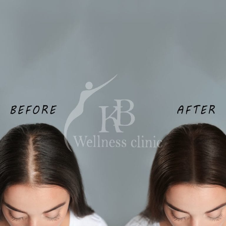 Hair Treatment1 at KB Wellness Clinic