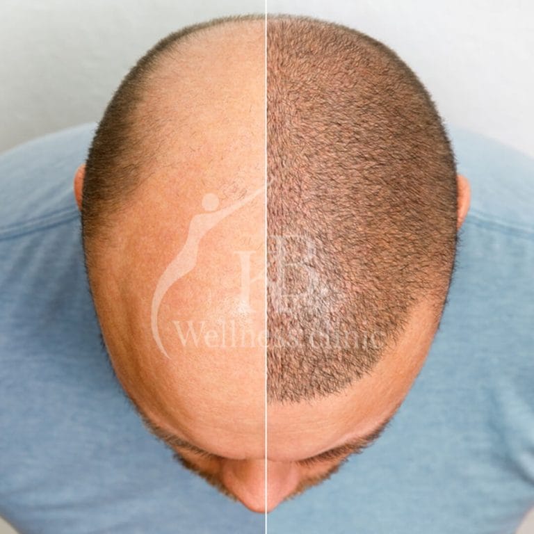 Hair Treatment2 at KB Wellness Clinic
