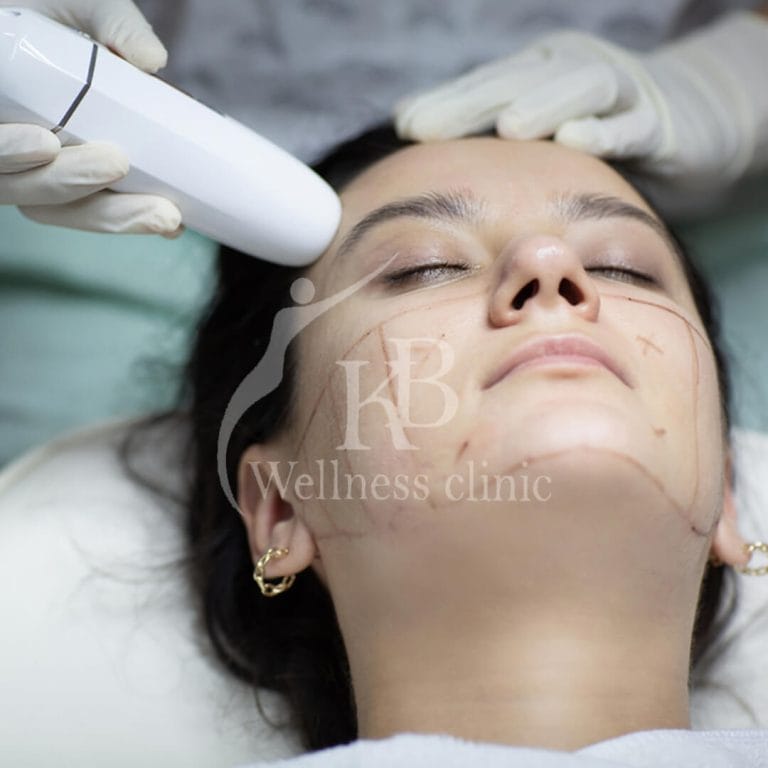 High Intensity Focused Ultrasound Hifu2 at KB Wellness Clinic