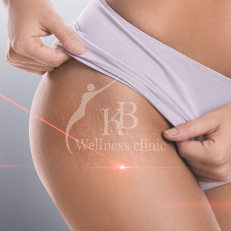 Stretch Marks1 at KB Wellness Clinic