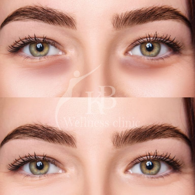 Under Eye Fillers1 at KB Wellness Clinic