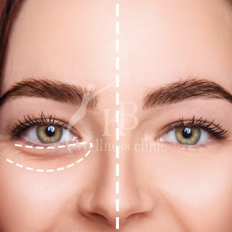 Under Eye Fillers2 at KB Wellness Clinic