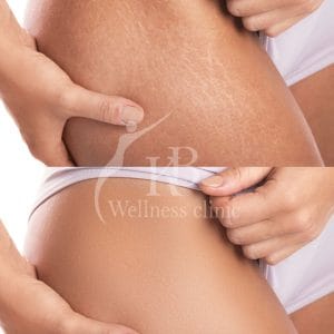 Non-surgical stretch marks removal treatment in Mumbai