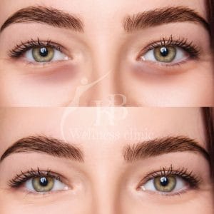 Under eye fillers treatment at Kavita Bubna Clinic Vile Parle East