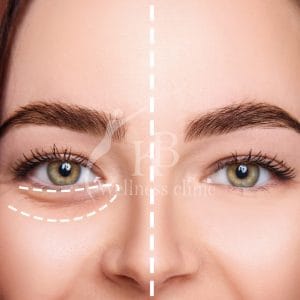 Non-surgical under eye filler procedure in Mumbai clinic