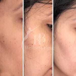 Before and after Viva technology skin tightening results