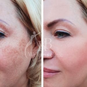 Mesotherapy in Vile Parle East