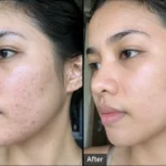 Acne Scar Treatment in Mumbai by dermatologist at Kavita Bubna Clinic